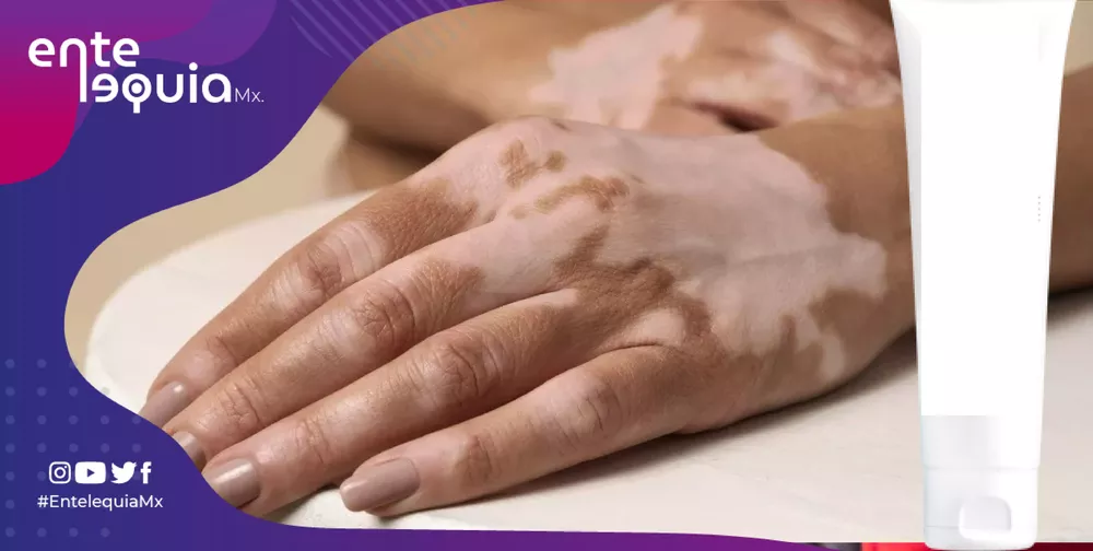 contra el vitiligo-01